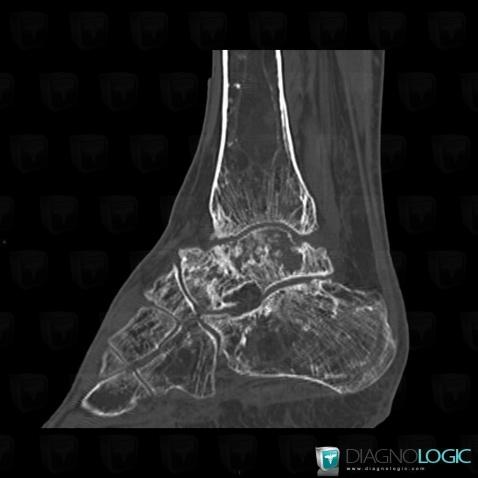 Avascular necrosis, Talus, CT