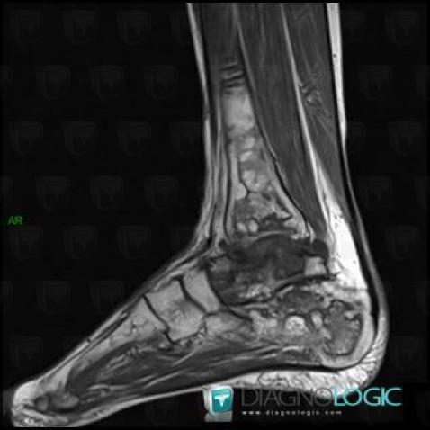 Avascular necrosis, Talus, MRI