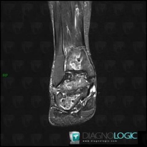 Avascular necrosis, Talus, MRI
