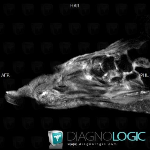 Avascular necrosis, Talus, MRI