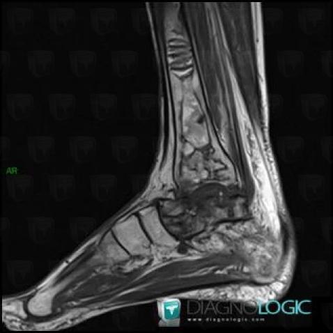 Avascular necrosis, Tibia - Distal part, MRI
