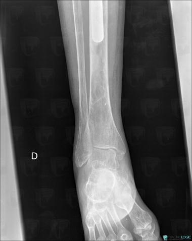 Avascular necrosis, Tibia - Distal part, X rays