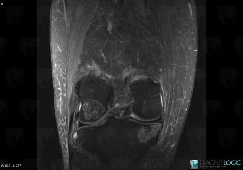 Avascular necrosis, Tibia - Proximal part, MRI