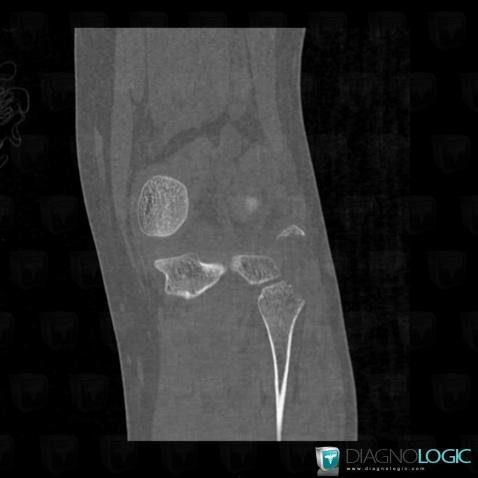 Avulsion fracture, Fibula - Proximal part, CT