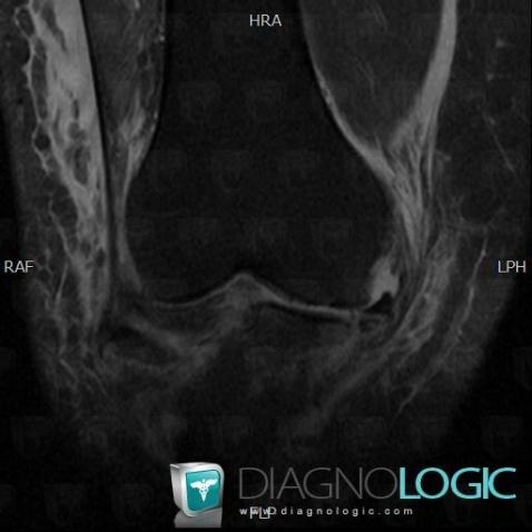 Avulsion fracture, Tibia - Proximal part, MRI