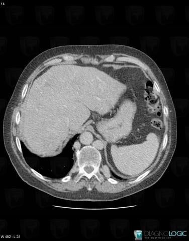 Azygos continuation-IVC, Inferior vena cava, CT