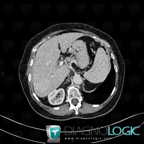 Azygos continuation-IVC, Inferior vena cava, CT