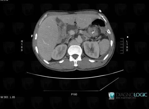 Azygos continuation-IVC, Inferior vena cava, CT