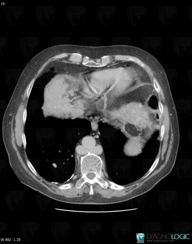 Azygos continuation-IVC, Mediastinum, CT