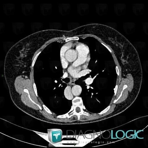 Azygos continuation-IVC, Mediastinum, CT