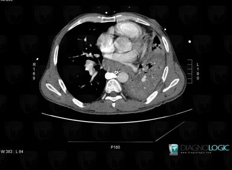 Azygos continuation-IVC, Mediastinum, CT