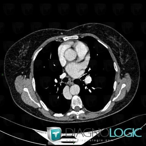 Azygos continuation-IVC, Paraspinal, CT