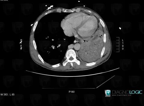 Azygos continuation-IVC, Paraspinal, CT