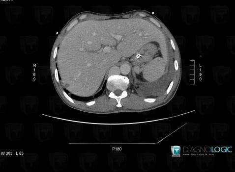 Azygos continuation-IVC, Veins - Thorax, CT