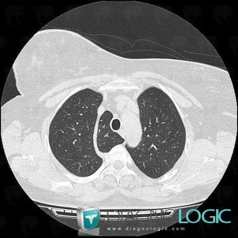 Azygos lobe, Pulmonary parenchyma, CT