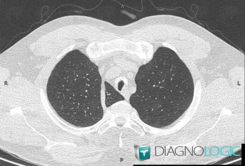 Azygos lobe, Pulmonary parenchyma, CT