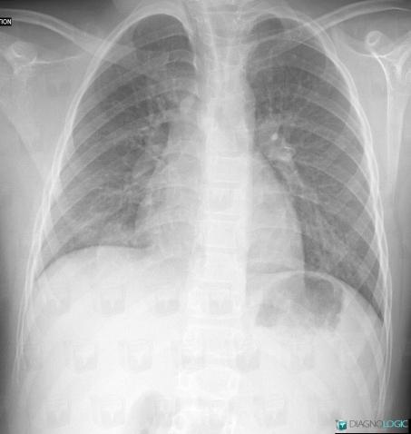 Azygos lobe, Veins - Thorax, X rays