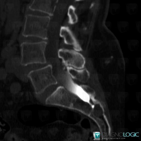 Baastrup  disease, Vertebral body / Disk, CT