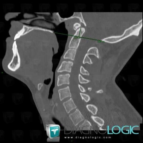 Basilar impression, Vertebral body / Disk, CT