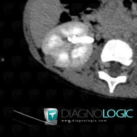 Beckwith-Wiedemann syndrome, Kidney, CT