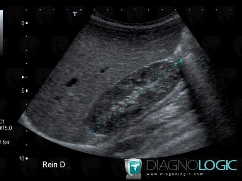 Beckwith-Wiedemann syndrome, Liver, US