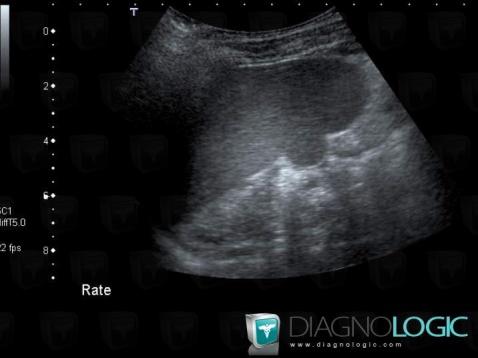 Beckwith-Wiedemann syndrome, Spleen, US