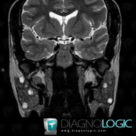 Benign lymphoepithelial cysts, Parotid and other salivary glands, MRI