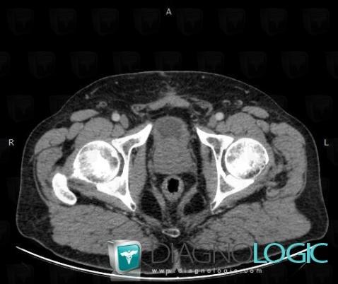 Benign prostatic hyperplasia, Prostate, CT