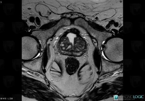 Benign prostatic hyperplasia, Prostate, MRI