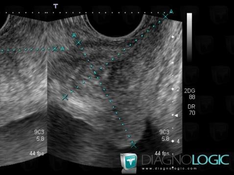 Radiology case : Benign prostatic hyperplasia (US) - Diagnologic