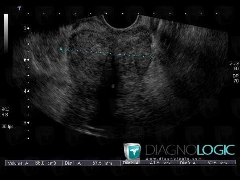 Benign prostatic hyperplasia, Prostate, US