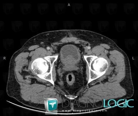 Benign prostatic hyperplasia, Urinary bladder, CT