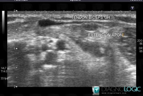 Biceps brachii tendon rupture, Biceps tendon - Elbow, US