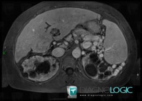 Biliary cystadenoma, Liver, MRI