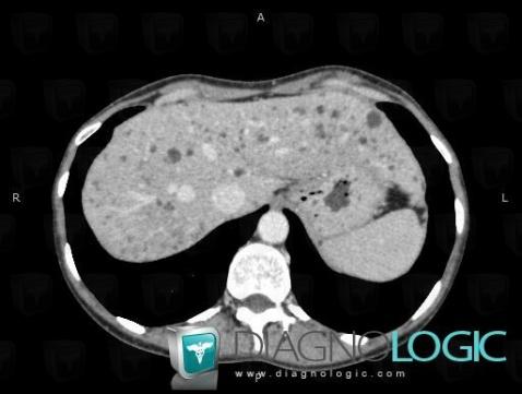 Biliary hamartoma, Liver, CT