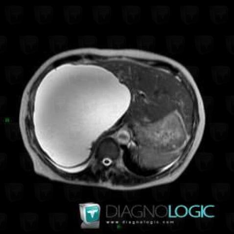 Biloma, Liver, MRI