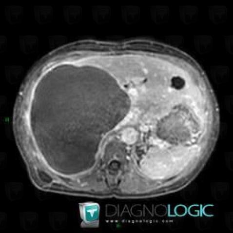 Biloma, Liver, MRI