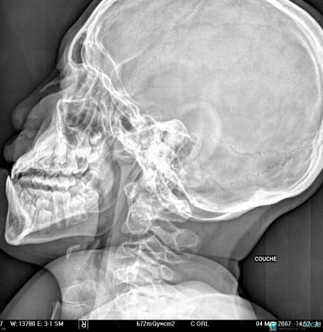 Binder syndrome, Mandible, X rays