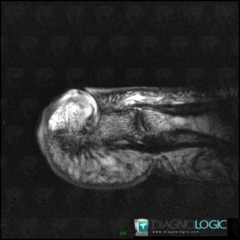 Bizarre parosteal pseudotumor, Other soft tissues/nerves - Foot, MRI