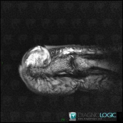 Bizarre parosteal pseudotumor, Phalanx / Sesamoid bones - Foot, MRI