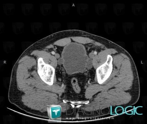 Bladder diverticulum, Urinary bladder, Pelvis / Perineum, CT