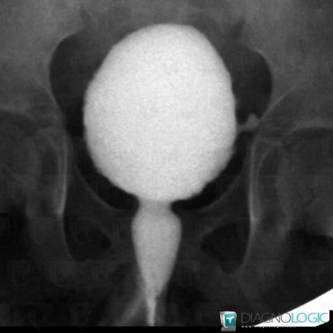 Bladder diverticulum, Urinary bladder, X rays