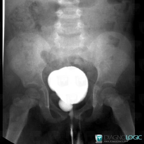 Bladder diverticulum, Urinary bladder, X rays