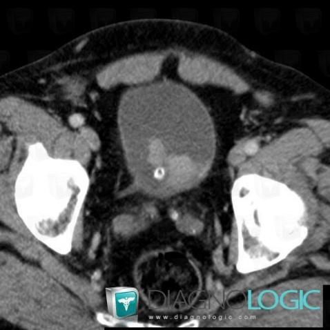 Bladder transitional cell carcinoma, Urinary bladder, CT