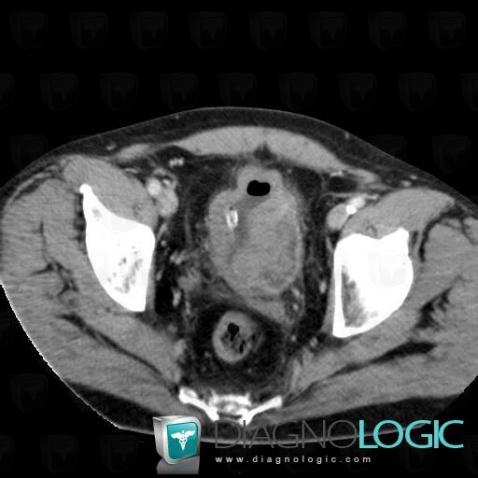 Bladder transitional cell carcinoma, Urinary bladder, CT