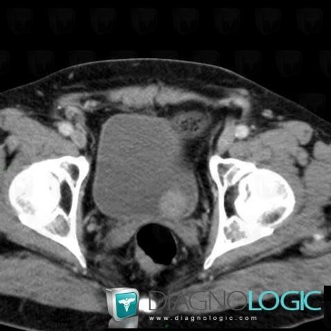 Bladder transitional cell carcinoma, Urinary bladder, CT