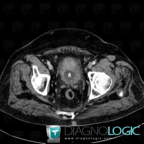 Bladder transitional cell carcinoma, Urinary bladder, CT