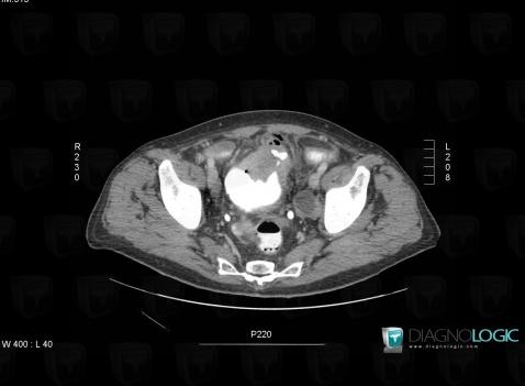 Bladder transitional cell carcinoma, Urinary bladder, CT