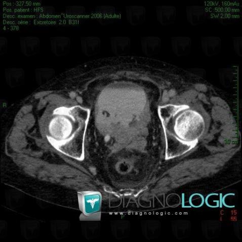 Bladder transitional cell carcinoma, Urinary bladder, CT