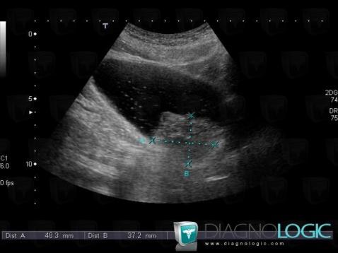 Bladder transitional cell carcinoma, Urinary bladder, US